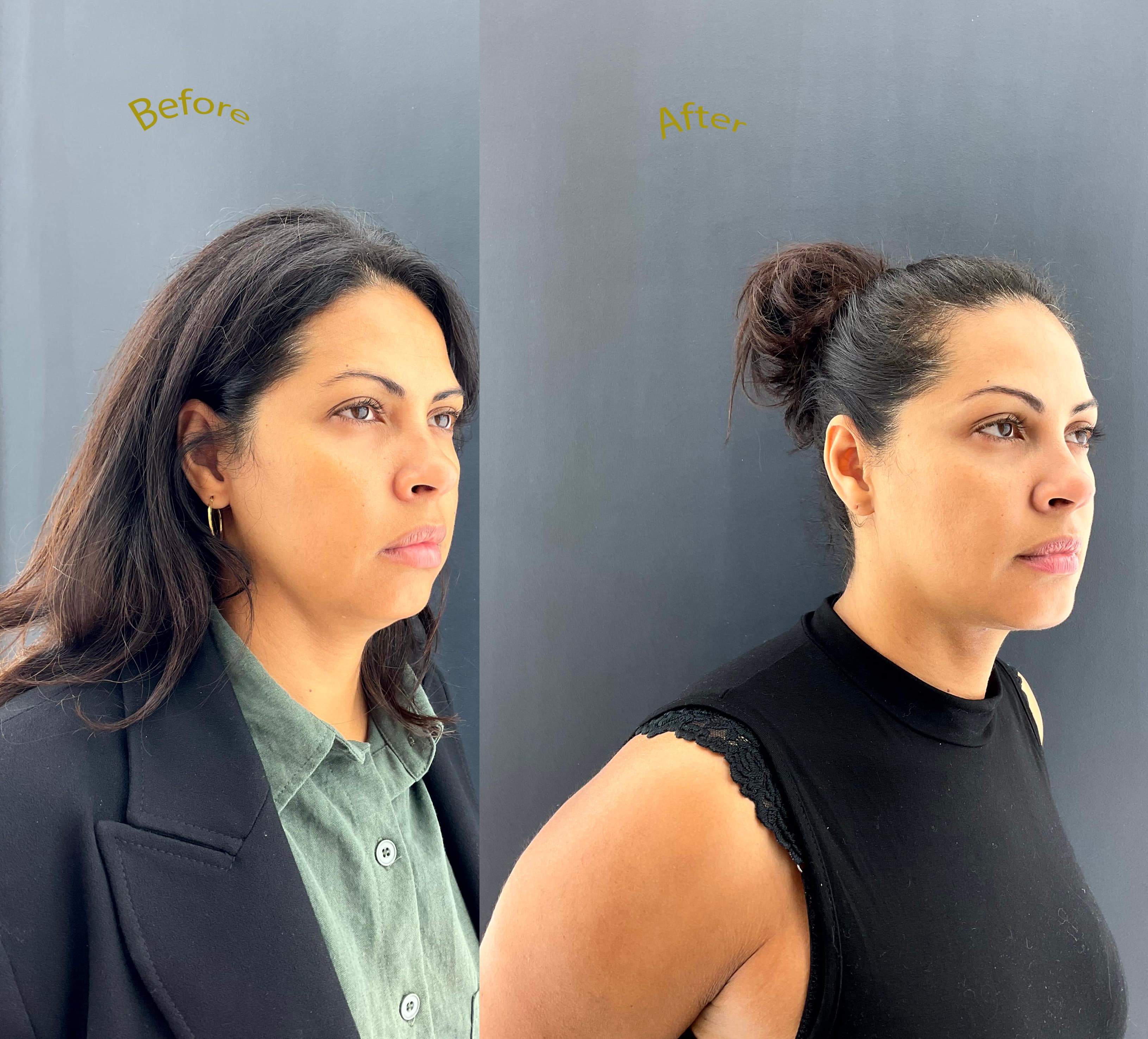 Facial surgery before and after