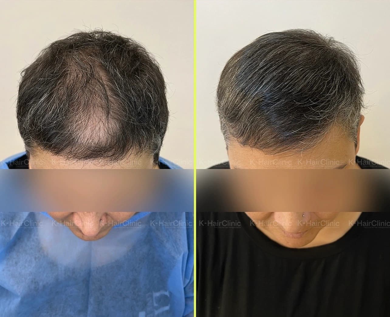 Hair transplant before and after