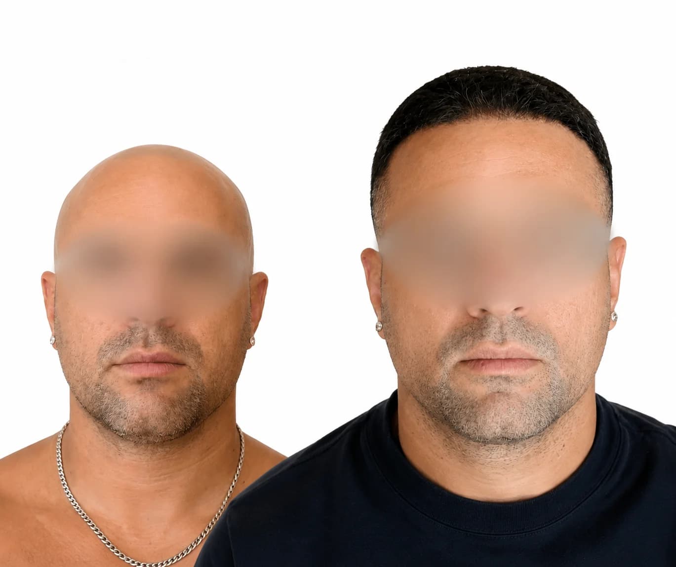Hair transplant before and after