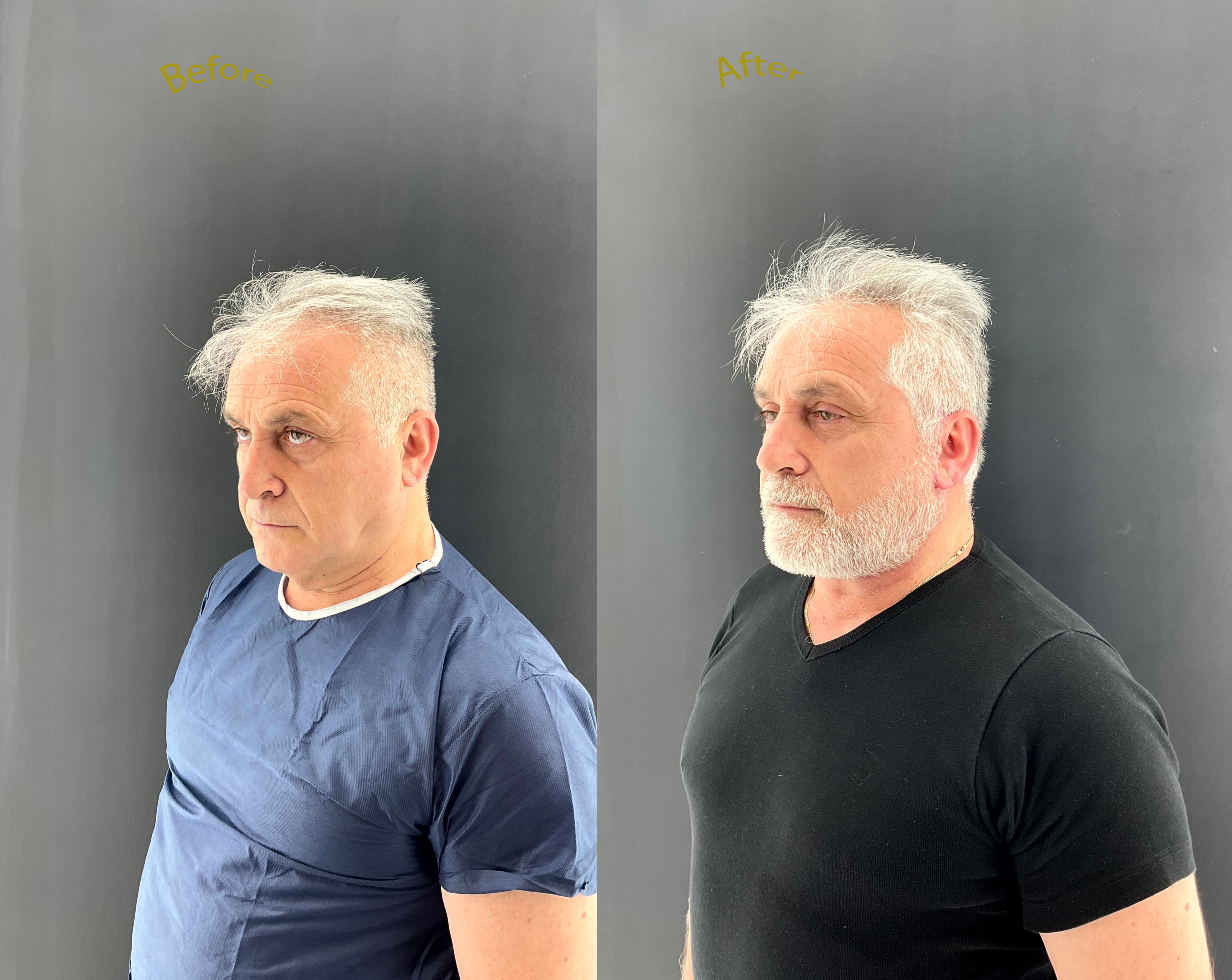 Face lift before and after