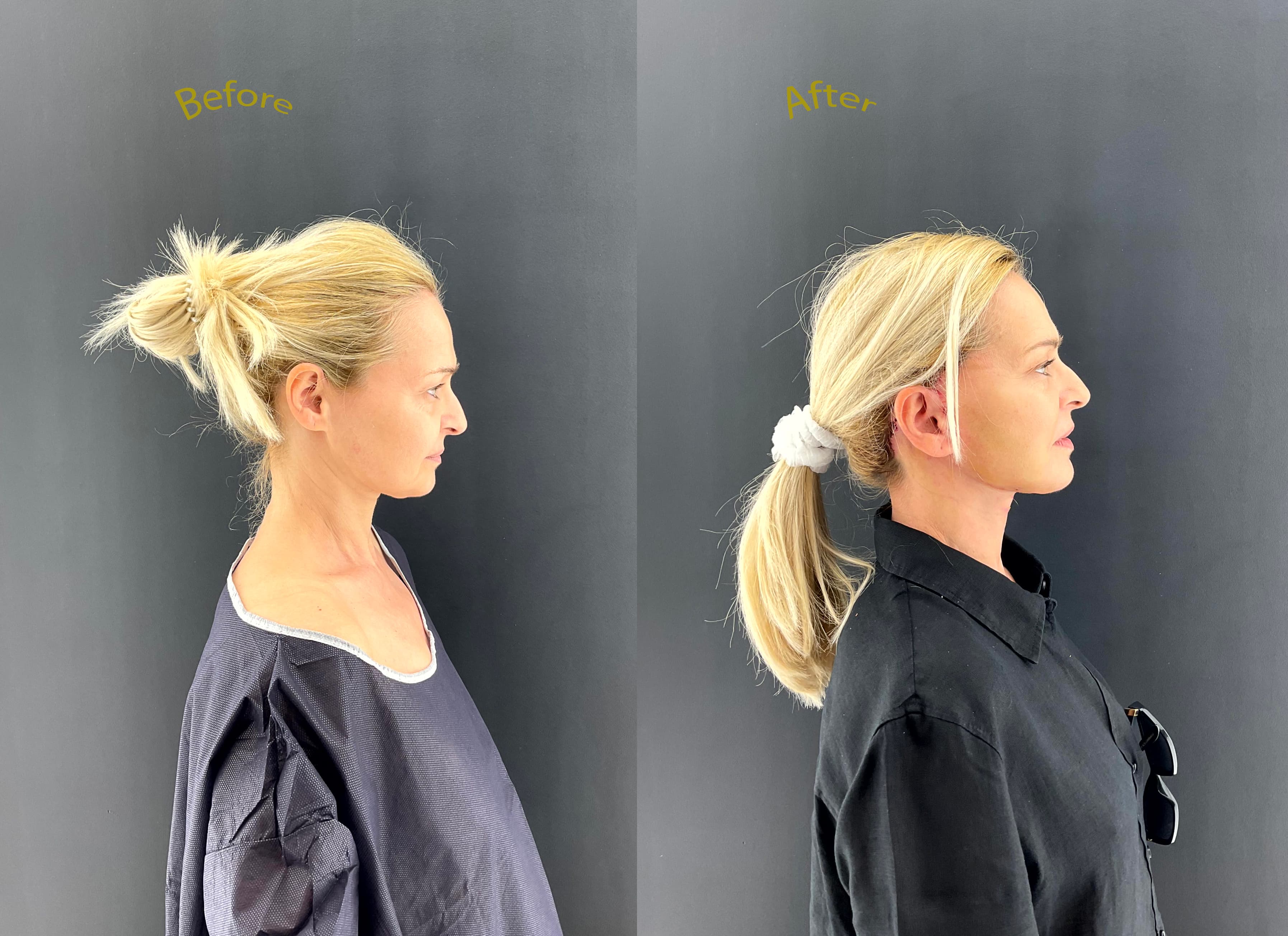 Deep-plane lift before and after