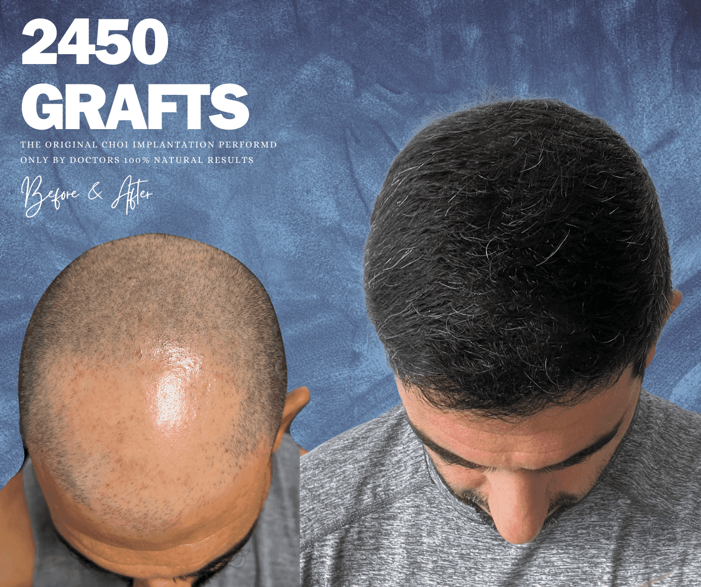 FUE restoration before and after